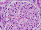 Case Z Biopsy Thumbnail Image 1
