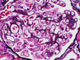 Case Z Biopsy Thumbnail Image 2