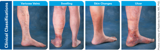 Clinical Classifications for Chronic Venous Insufficiency