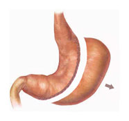 gastric sleeve