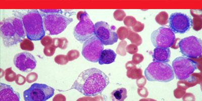 Hematological Malignancies