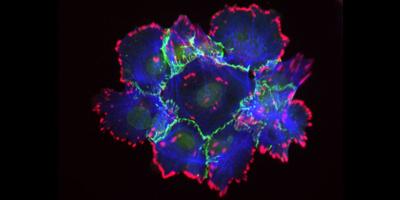 Mouse breast tumor cells. E-cadherin in green, vinculin in red, and actin in blue. Image credit: Weiyi Xu, Turner lab