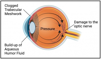 exfoliation glaucoma image
