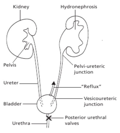 hydronephrosis
