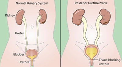 posterior urethral valve