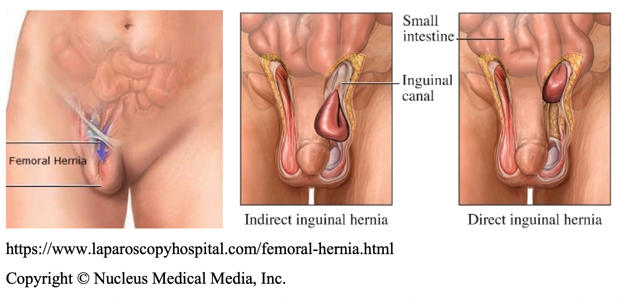 Hérnia inguinal