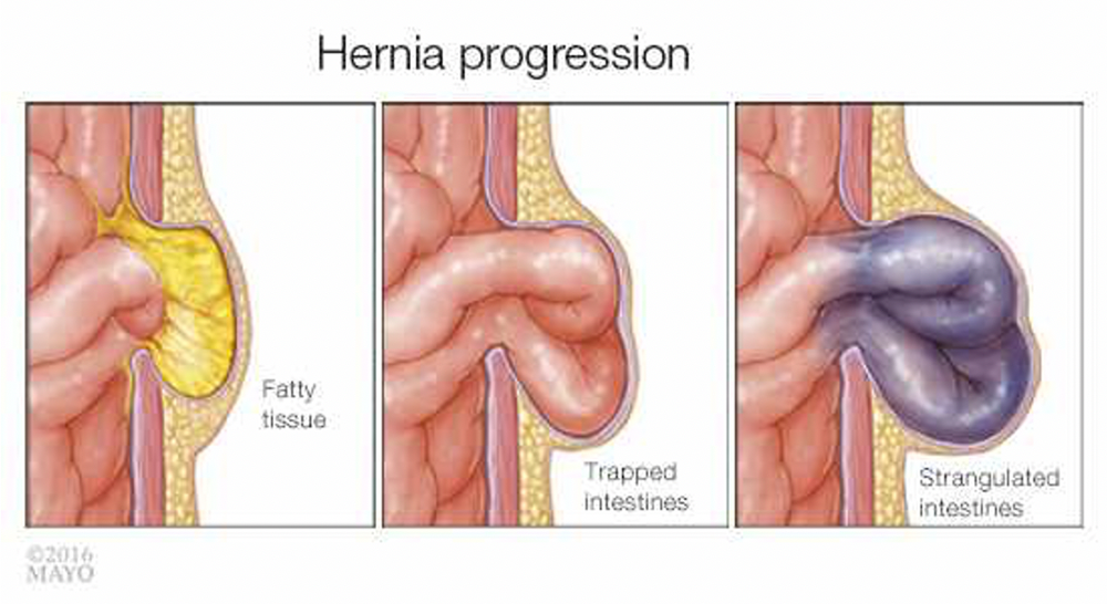 Hernia Progression