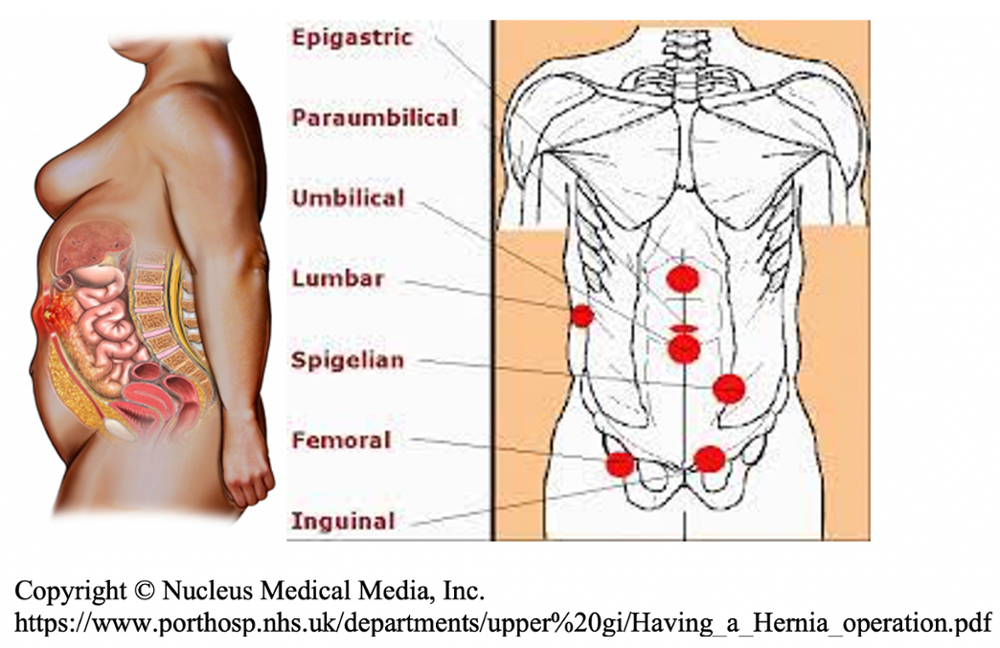 Ventral Hernia, Hernia Surgery