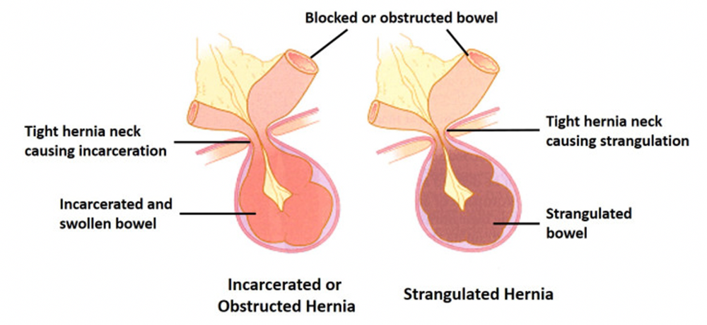 What is Hernia Emergency?