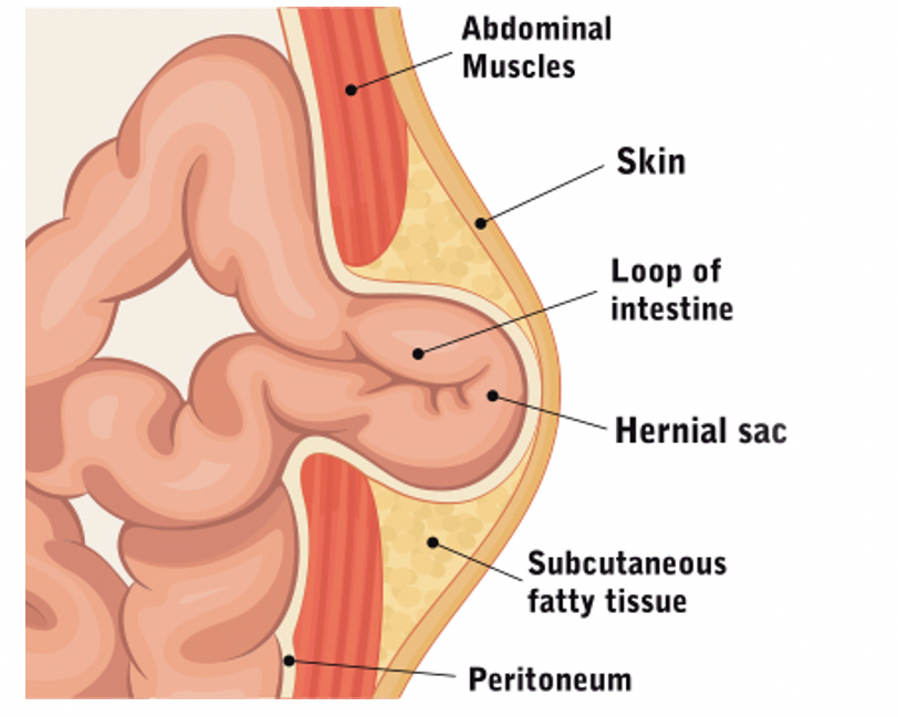 What is Hernia?