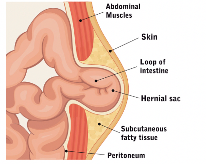 About Hernias, Hernia Surgery