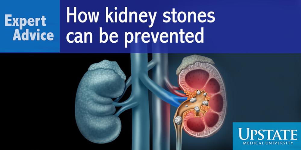 Ideas on how kidney stones can be prevented.