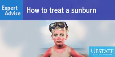 Expert Advice: How to treat a sunburn