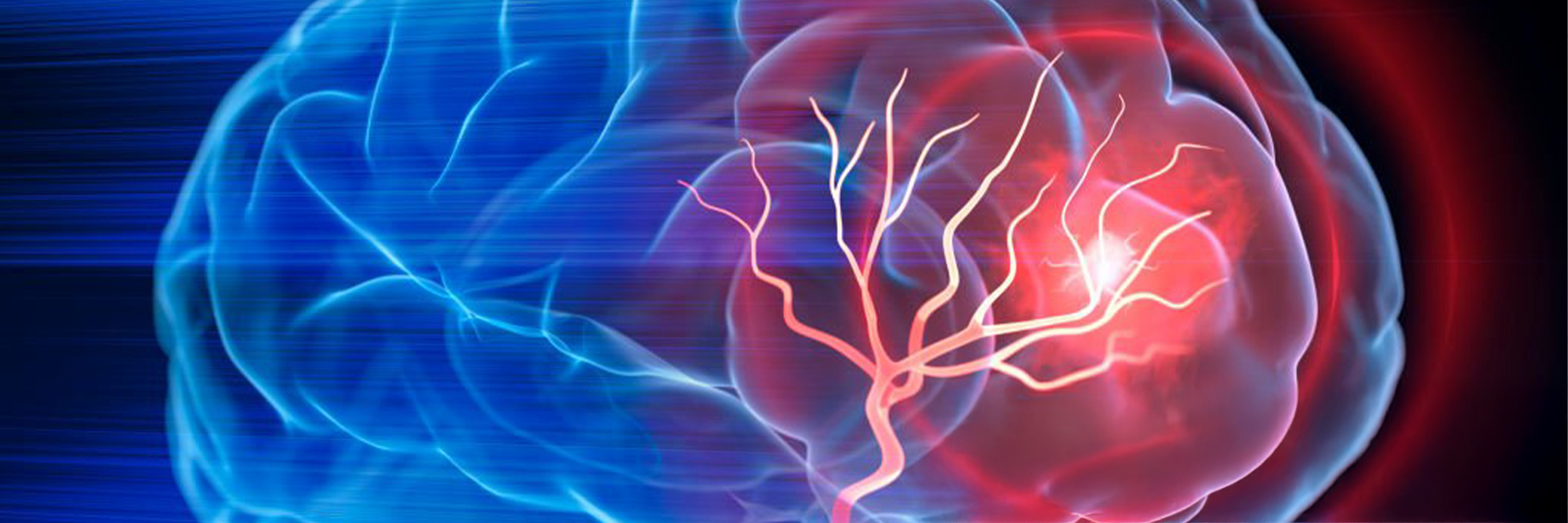 Image of brain with stroke