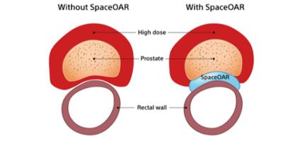 Upstate now using revolutionary hydrogel to protect organs during radiation for prostate cancer