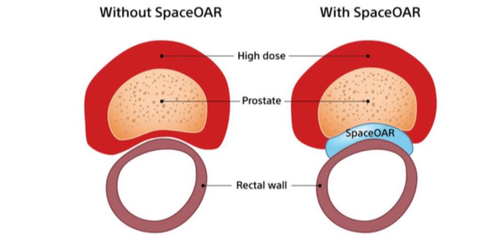 An illustration of what SpaceOAR gel looks like in the body.