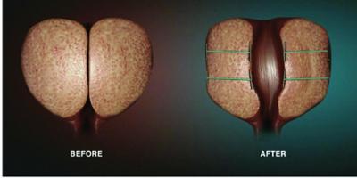 Upstate expands treatment options for men with enlarged prostates with UroLift