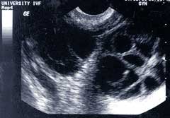 This image shows the ovarian folicles after treatment of fertility medication.