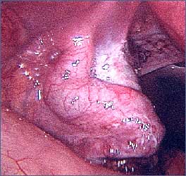 Hydrosalpianx