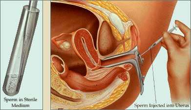 Pictured above, is a demonstration of intrauterus insemination.