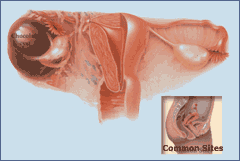 Endometriosis Disease