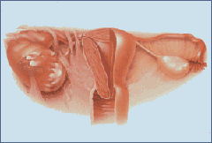 Pelvic Inflammatory Disease