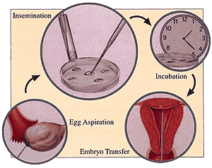 In IVF, eggs are harvested from the woman's ovary and fertilized in the laboratory with sperm. The embryos are then transferred into the uterus of the patient.