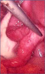 Normal Fallopian Tube