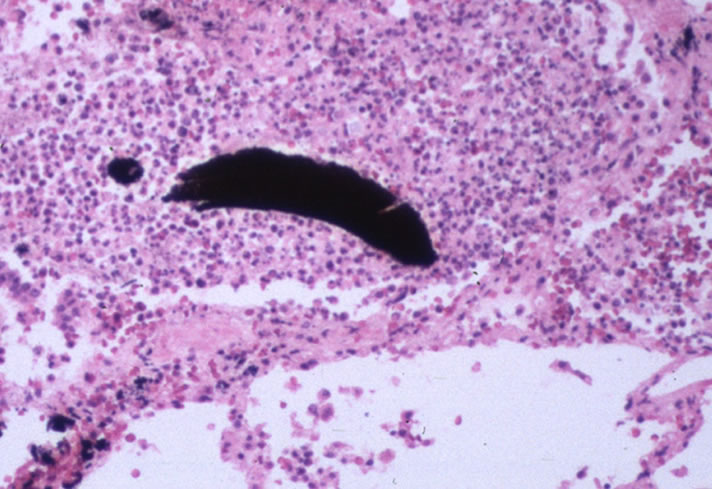 LM1