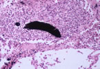 LM1