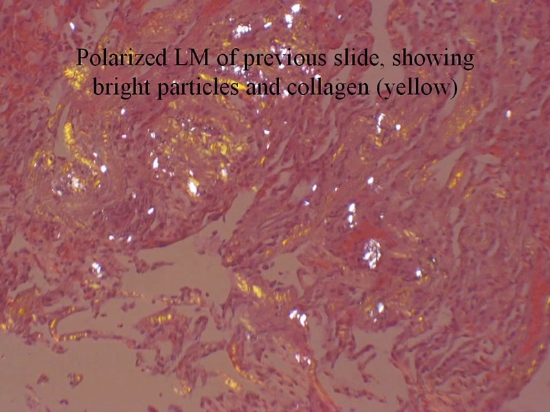 Upstate Medical Center >> Case 9 | Particle Analysis | SUNY Upstate Medical University Upstate Medical Center >> Case 9 | Particle Analysis | SUNY Upstate Medical University