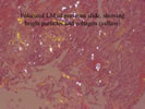Polarized LM of parenchymal area