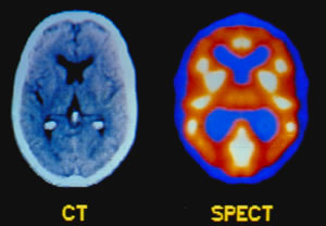 An MRI of a psychiatric patient