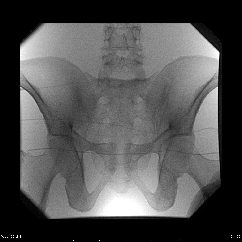 (Pelvis) | Radiology | SUNY Upstate Medical University