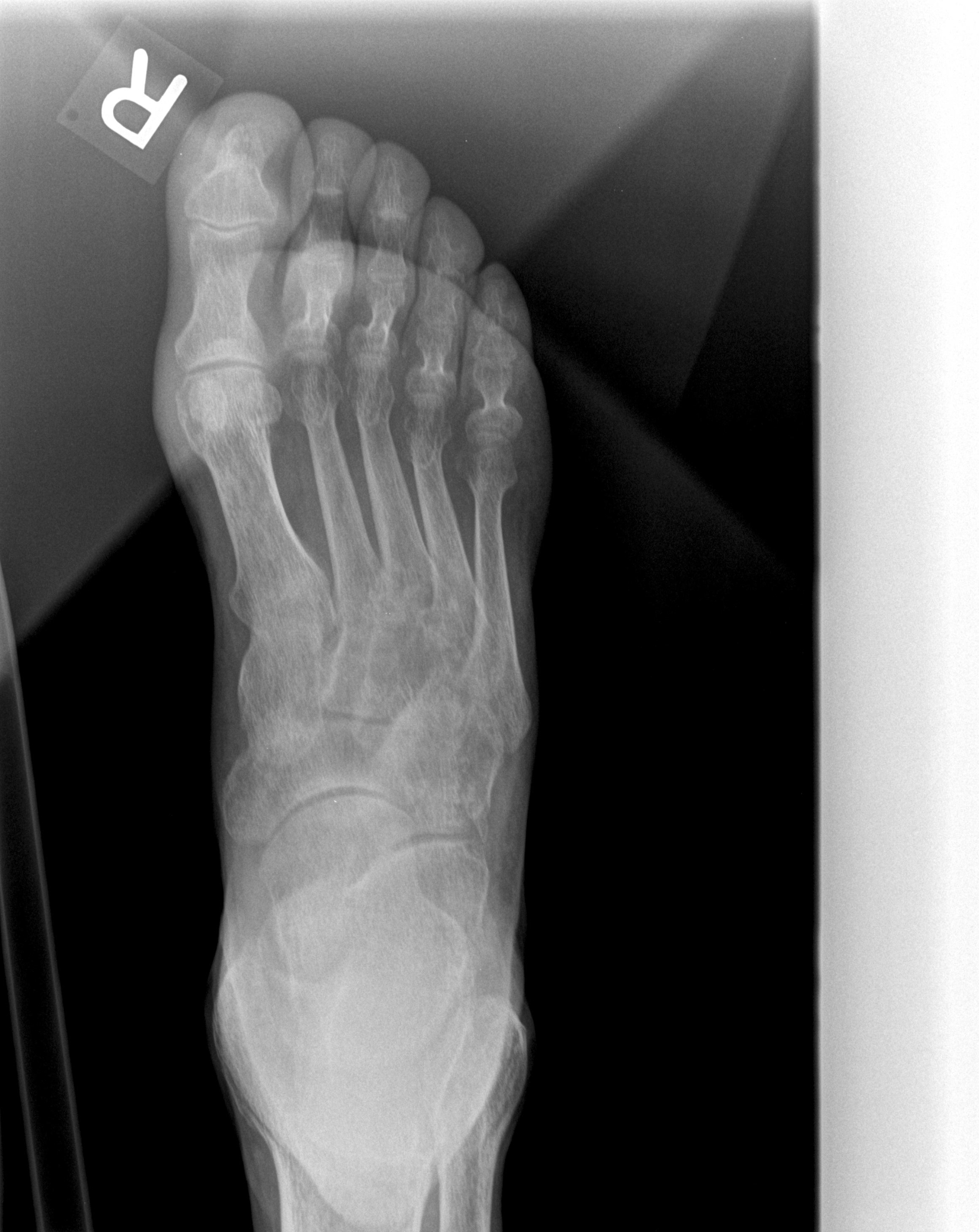 Digital Radiography Image Artifacts | Radiology | SUNY Upstate