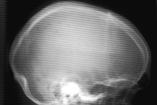Digital Radiography Image Artifacts | Radiology | SUNY Upstate Medical