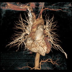 CT Angiogram