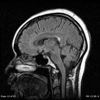 Brain MRI