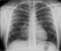Chest x-ray
