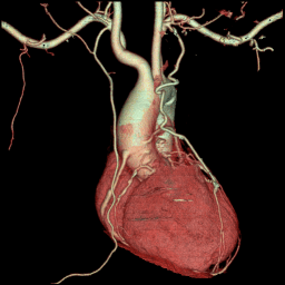 Cardiac CT Angiogram