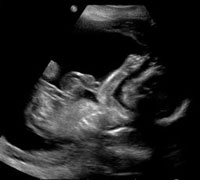 Fetal Ultrasound