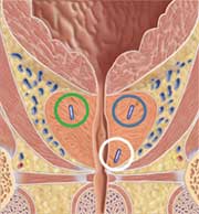 Three implanted Beacon® electromagnetic transponders within the prostate