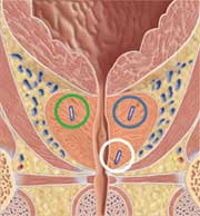 Three implanted BeaconÂ® electromagnetic transponders within the prostate