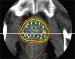 CT scan of prostate following completion of the implant 