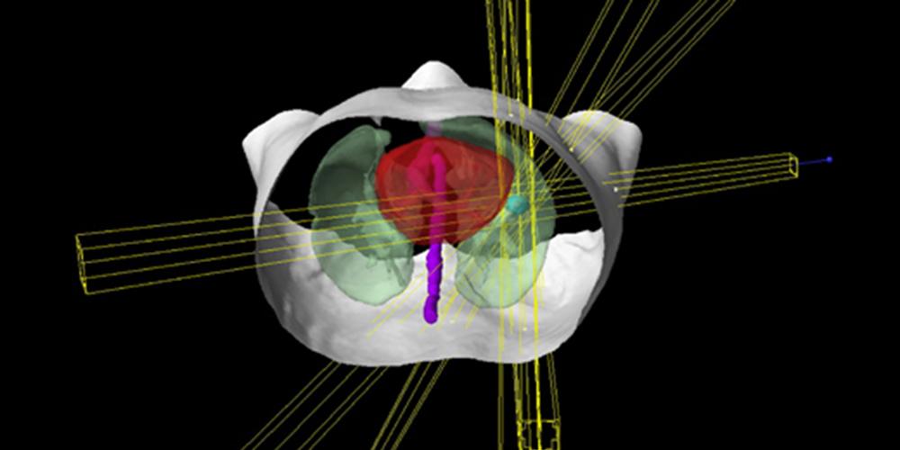 trubeam targeting tumor