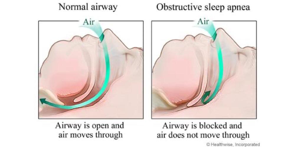 Normal airway, airway is open and air moves through, obstructive sleep apea the airway is blocked and air does not move through