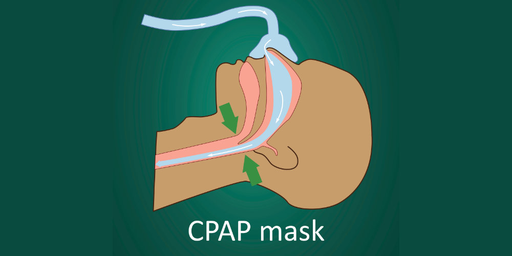 CPAP mask diagram