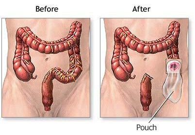 Before and after image of colostomy