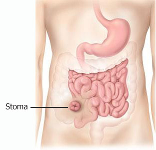 Image of an ileostomy