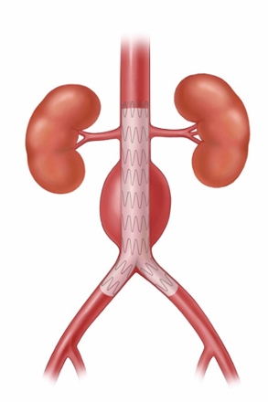 Endovascular Aortic Aneurysm Repair